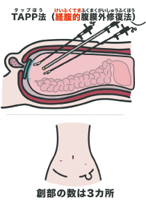 腹腔鏡手術（TAPP）