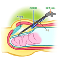 内視鏡手術(TEP法)